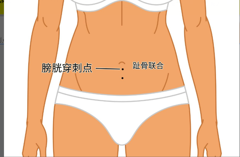 膀胱穿刺点的位置图片 膀胱穿刺术位置