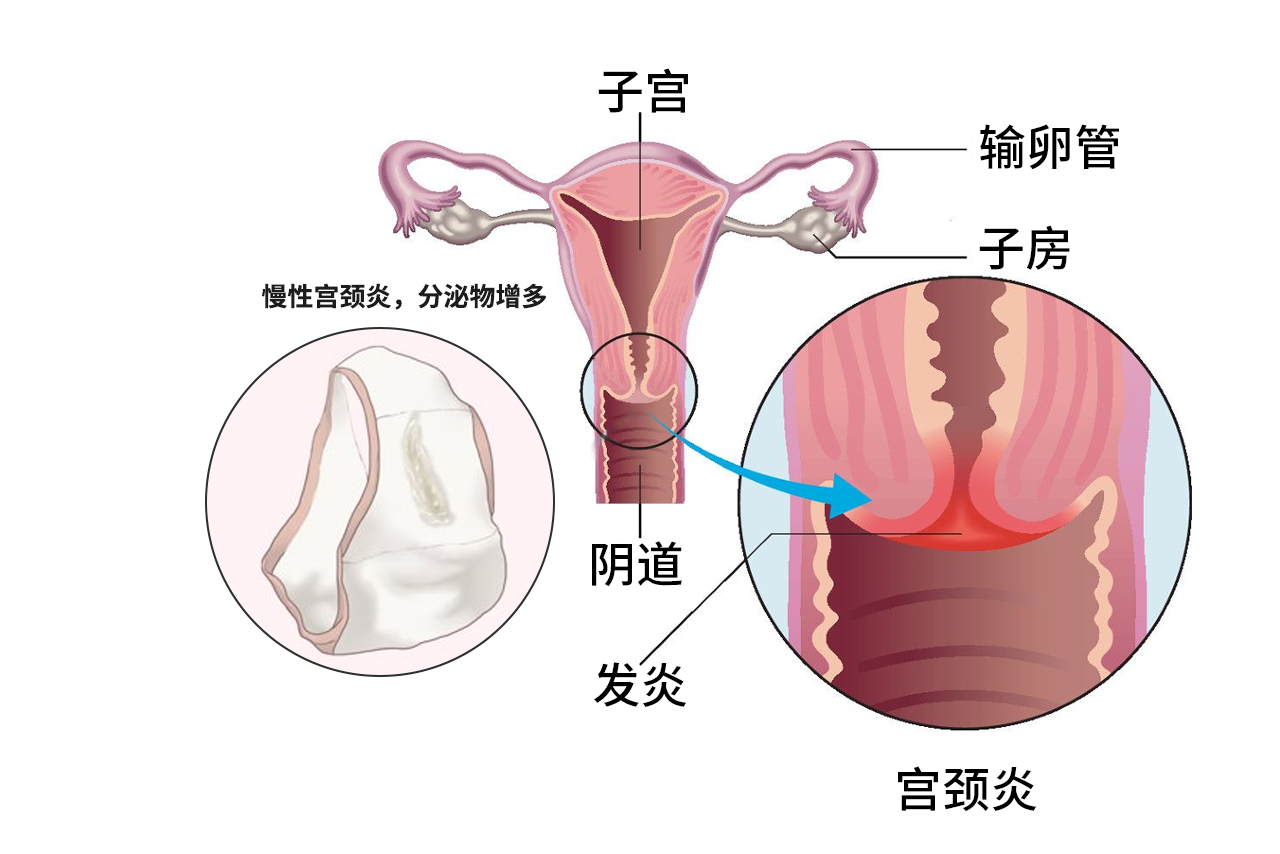 慢性宫颈炎内裤的图片 慢性子宫颈炎图片