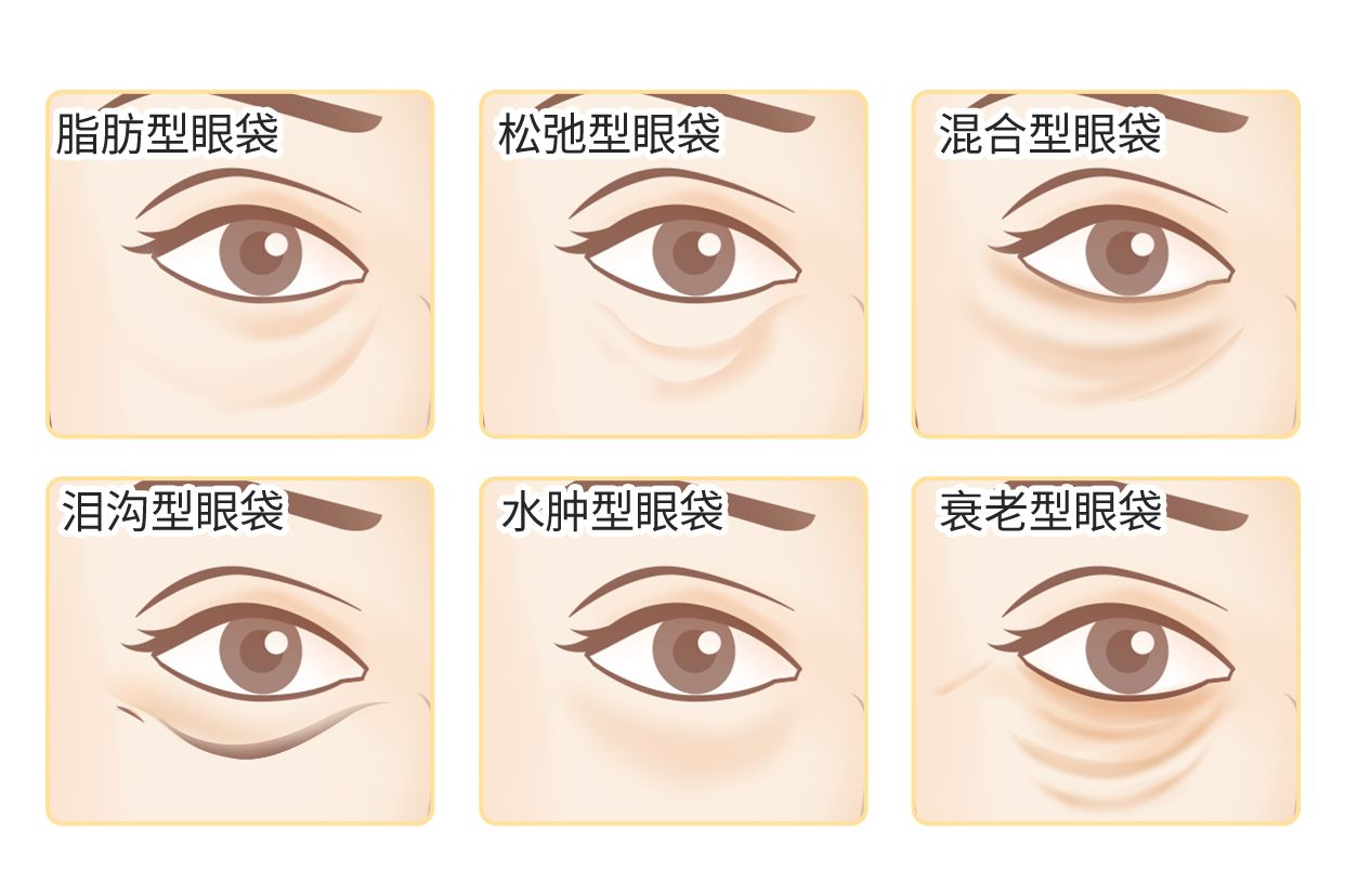 六种眼袋类型图片（眼袋有几种类型图片）