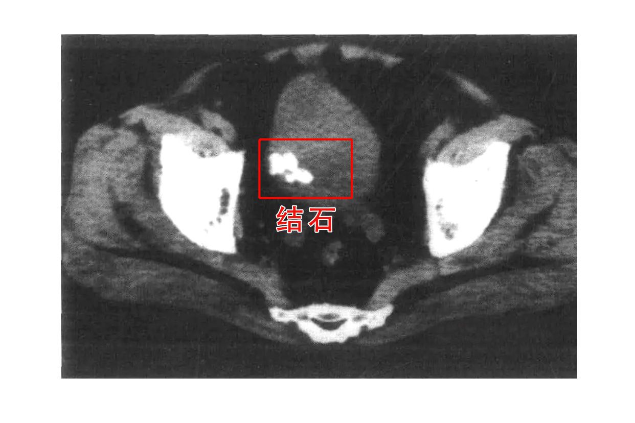 膀胱结石ct图片（膀胱结石拍片图片）