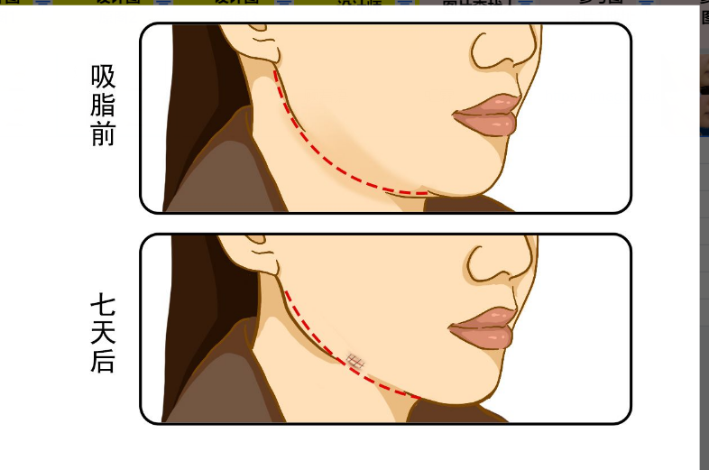 下颌缘吸脂7天恢复图 下颌缘抽脂多久才能看出效果