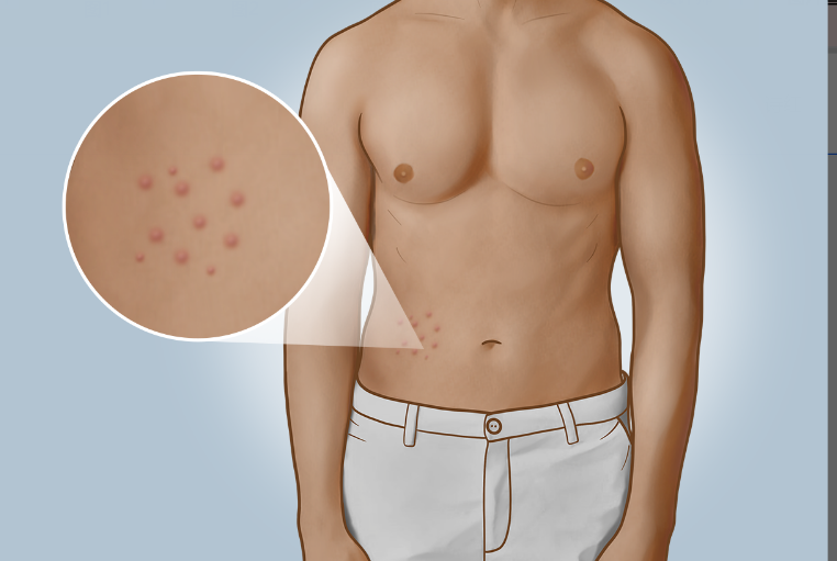 肚子上长红色的痘痘是怎么回事图片 扫一扫识别皮肤病