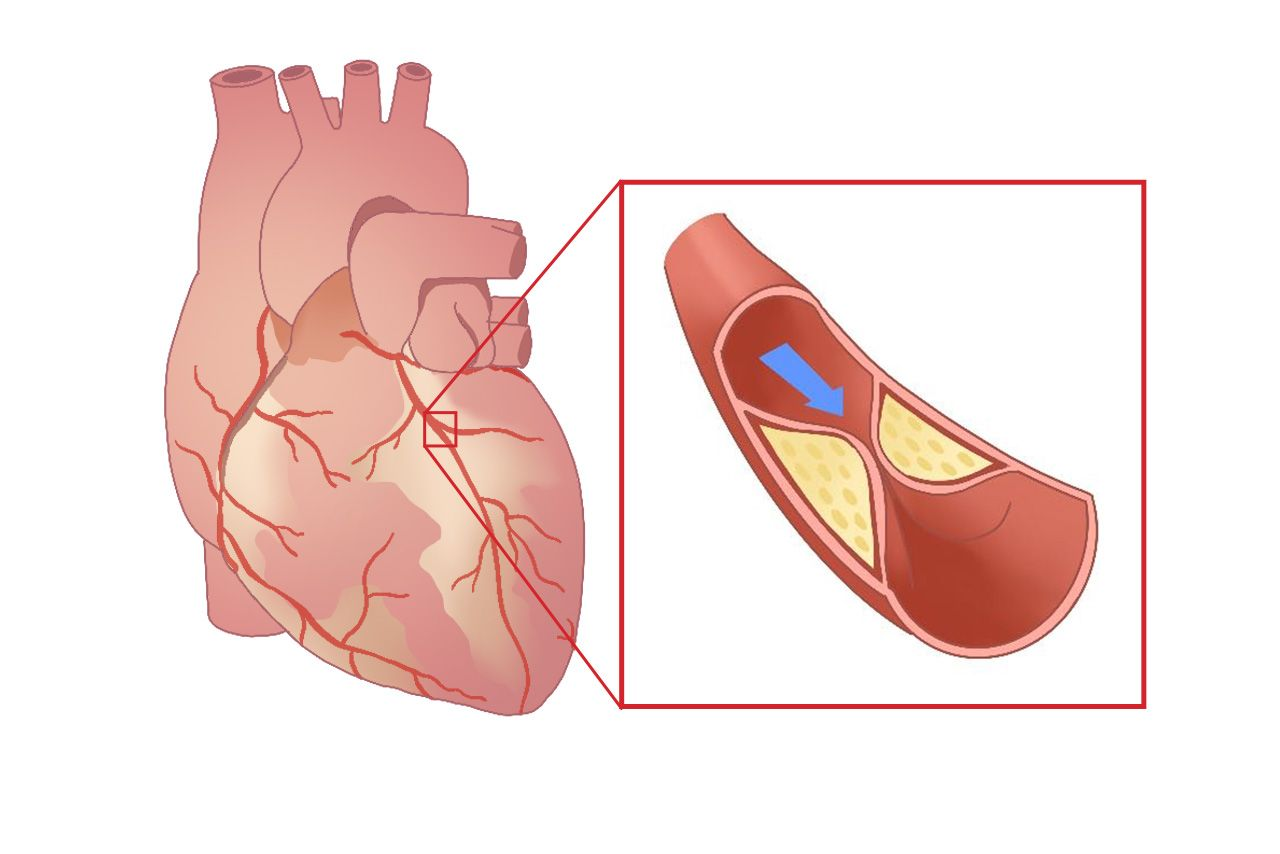 心血管狭窄图片（心血管狭窄图片高清）