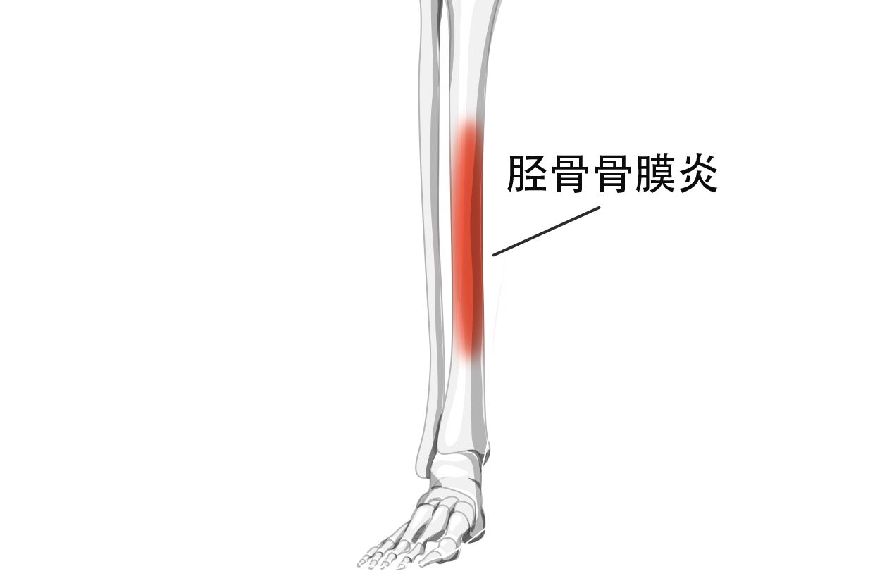 小腿胫骨骨膜炎图片 小腿胫骨骨膜炎症状