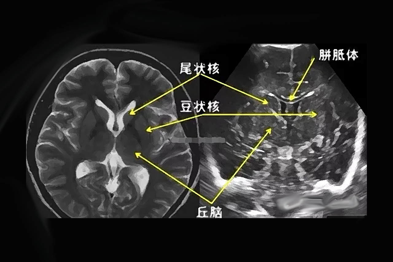 胎儿颅内结构正常超声图谱 新生儿颅脑超声解剖图谱