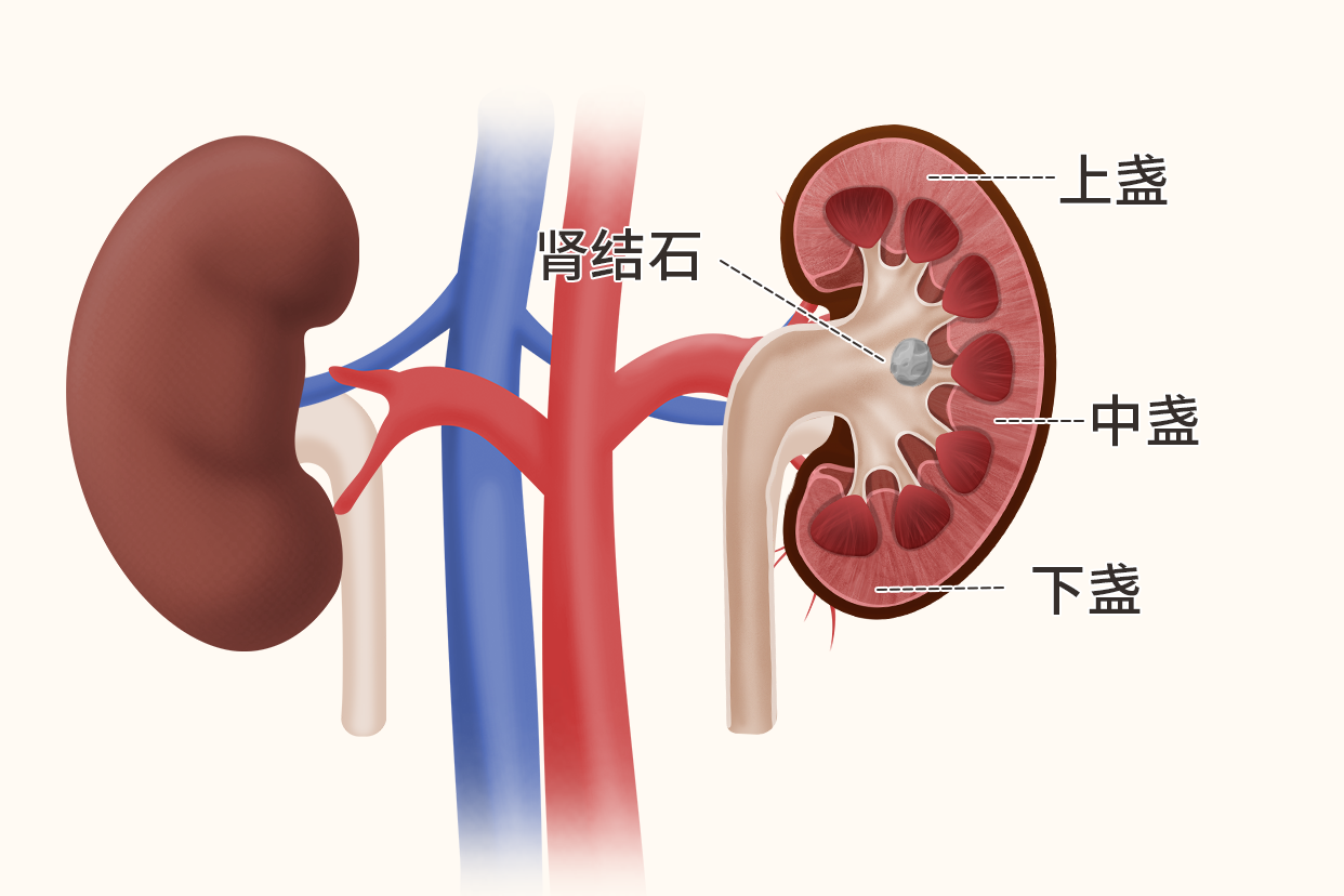 肾中盏结石图片