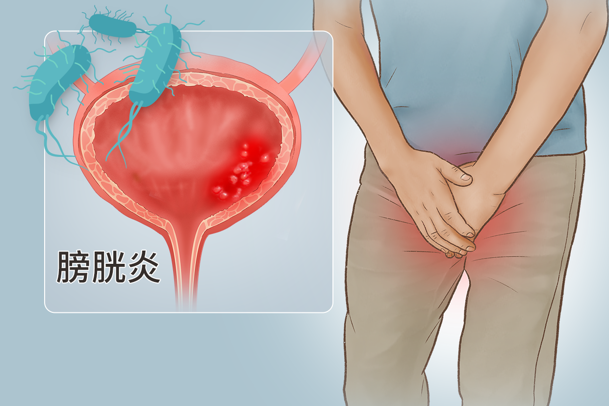男性膀胱炎图片