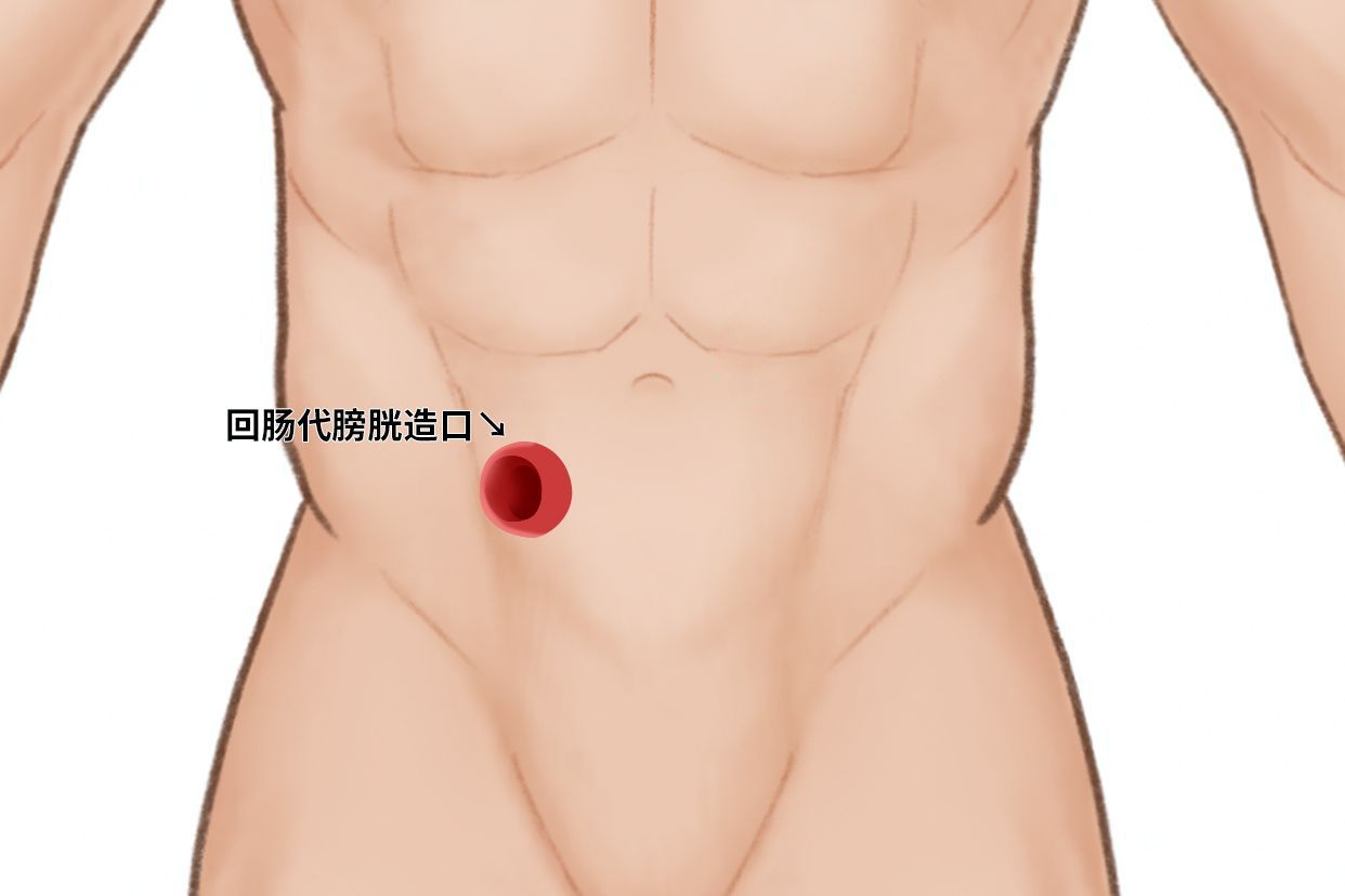 回肠代膀胱造口图片 回肠膀胱腹壁造口