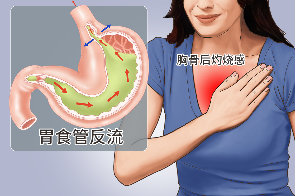 胃食管反流图片（胃食管反流图片高清）