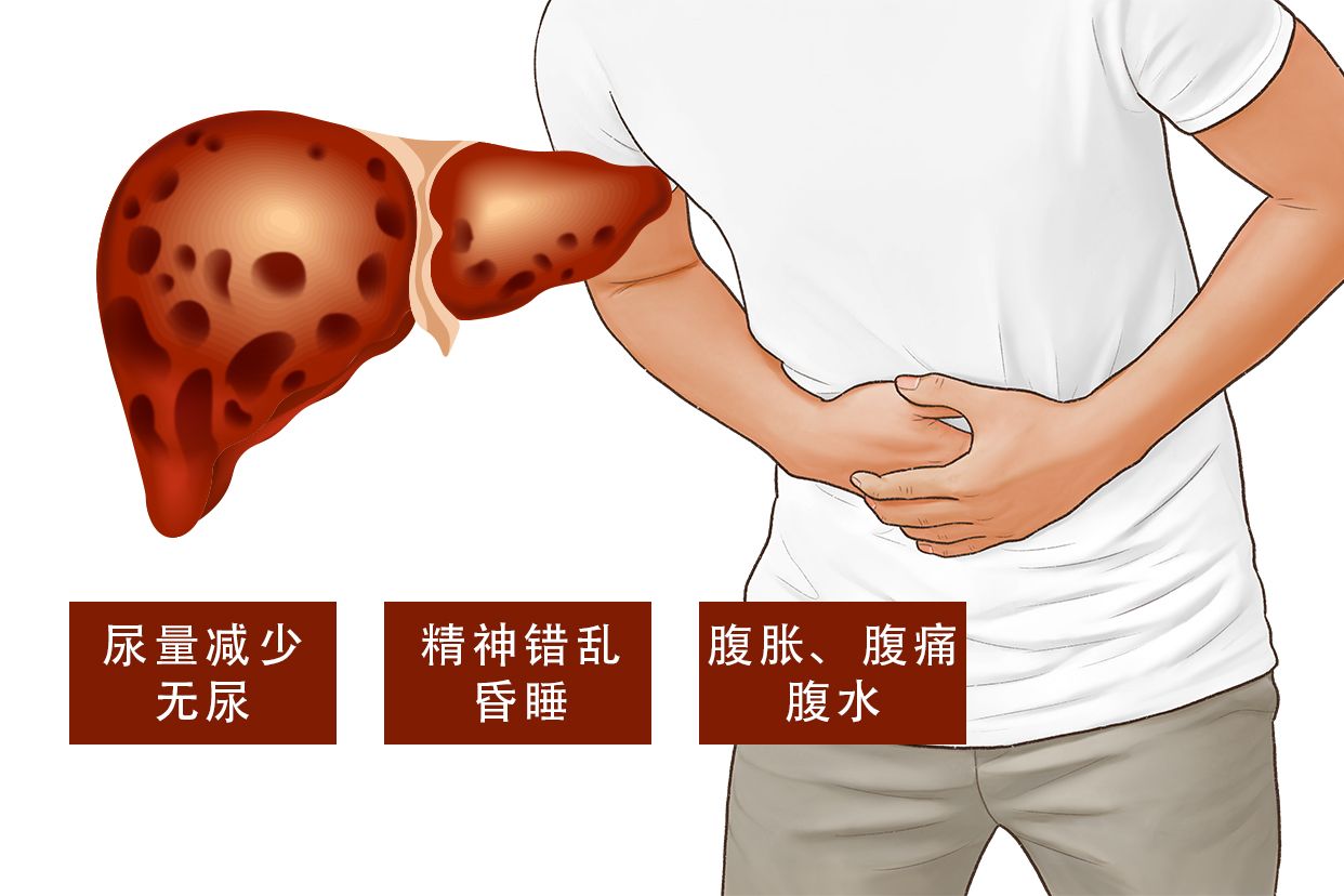 肝衰竭图片 肝衰竭图片卡通