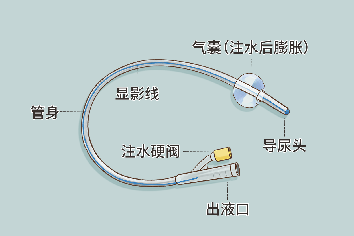 膀胱造瘘引流导尿管的图片（膀胱造瘘管图片介绍）