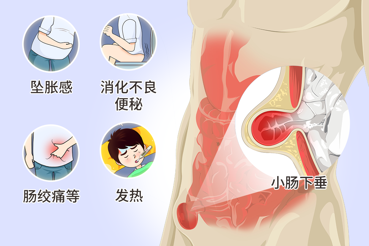 什么是小肠下垂图片 什么是小肠下垂图片女