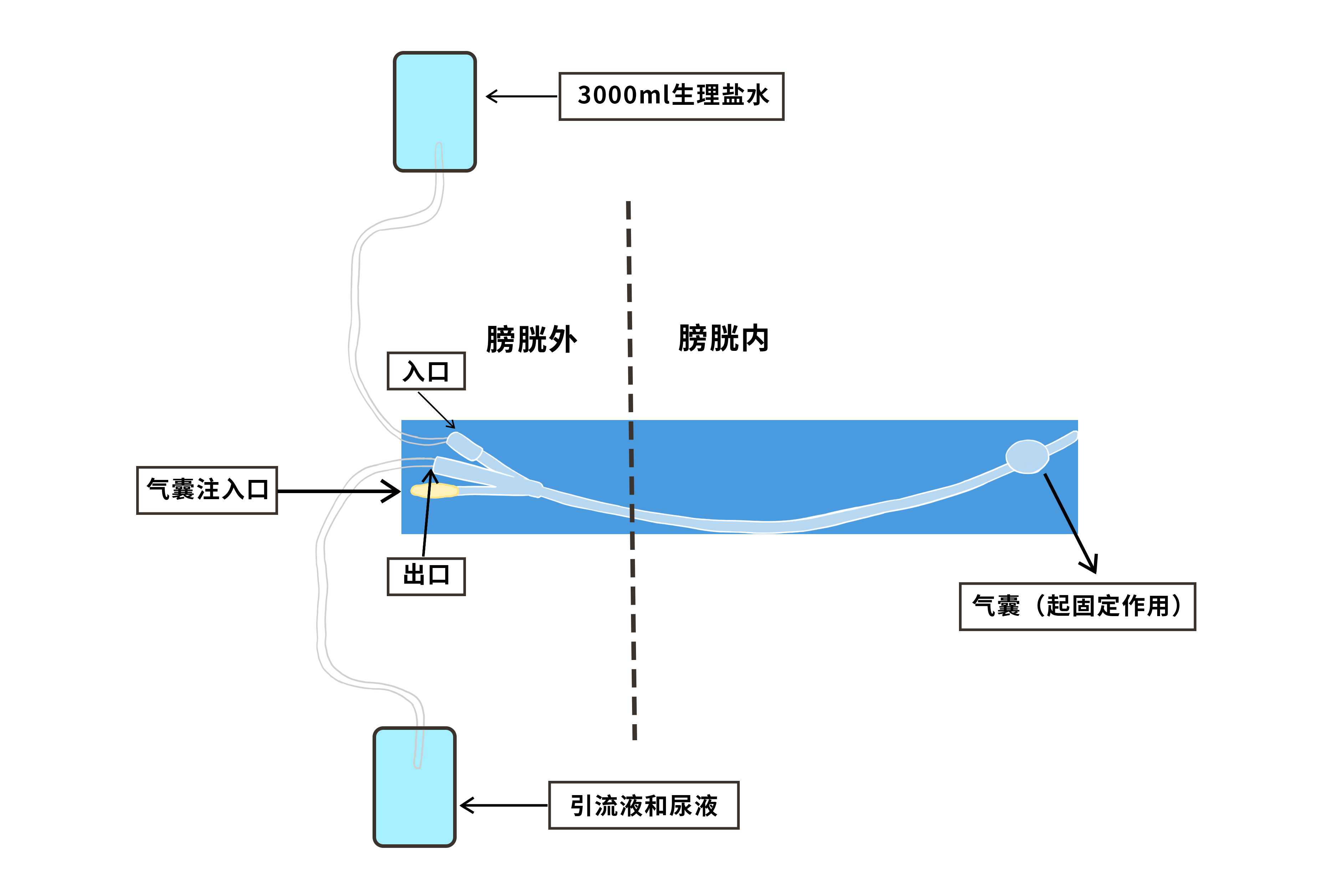 膀胱冲洗接哪个尿管头求图