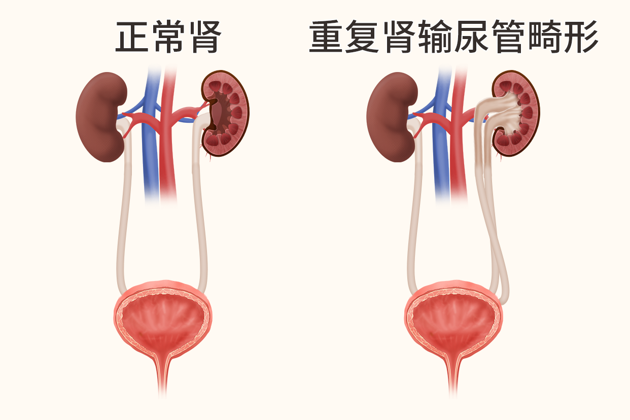 双肾双输尿管图片