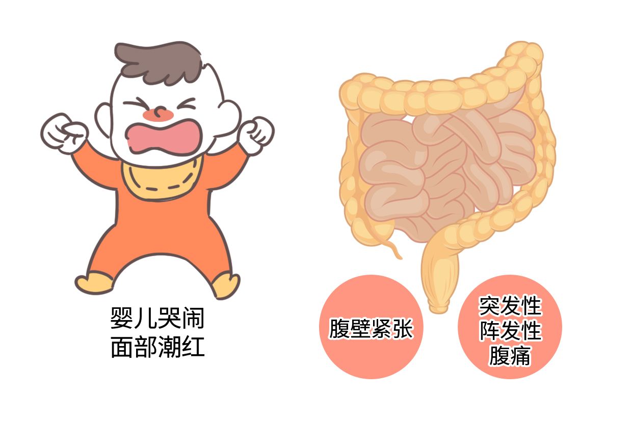 肠痉挛图片