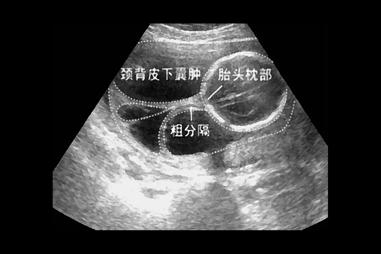 四个月胎儿颈部水囊瘤图片