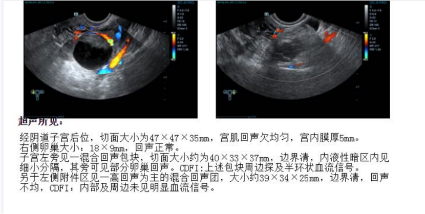 25岁女子产检发现卵巢瘤，通过手术成功切除