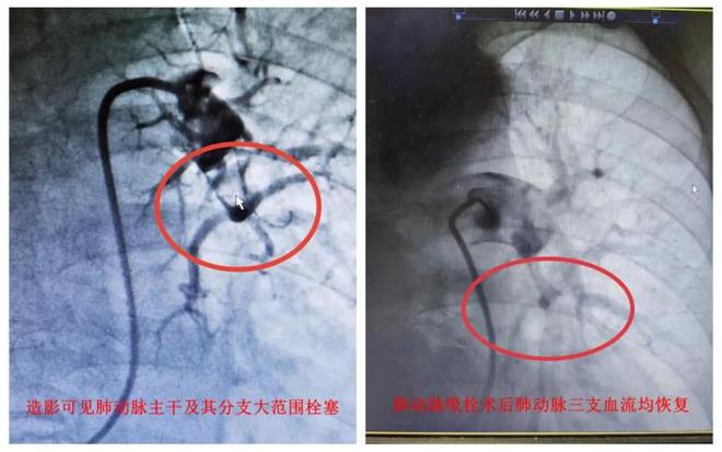 阳性一个月后，风险增加33倍！这些同时就医的肺梗心梗患者，竟都和出汗脱水有关