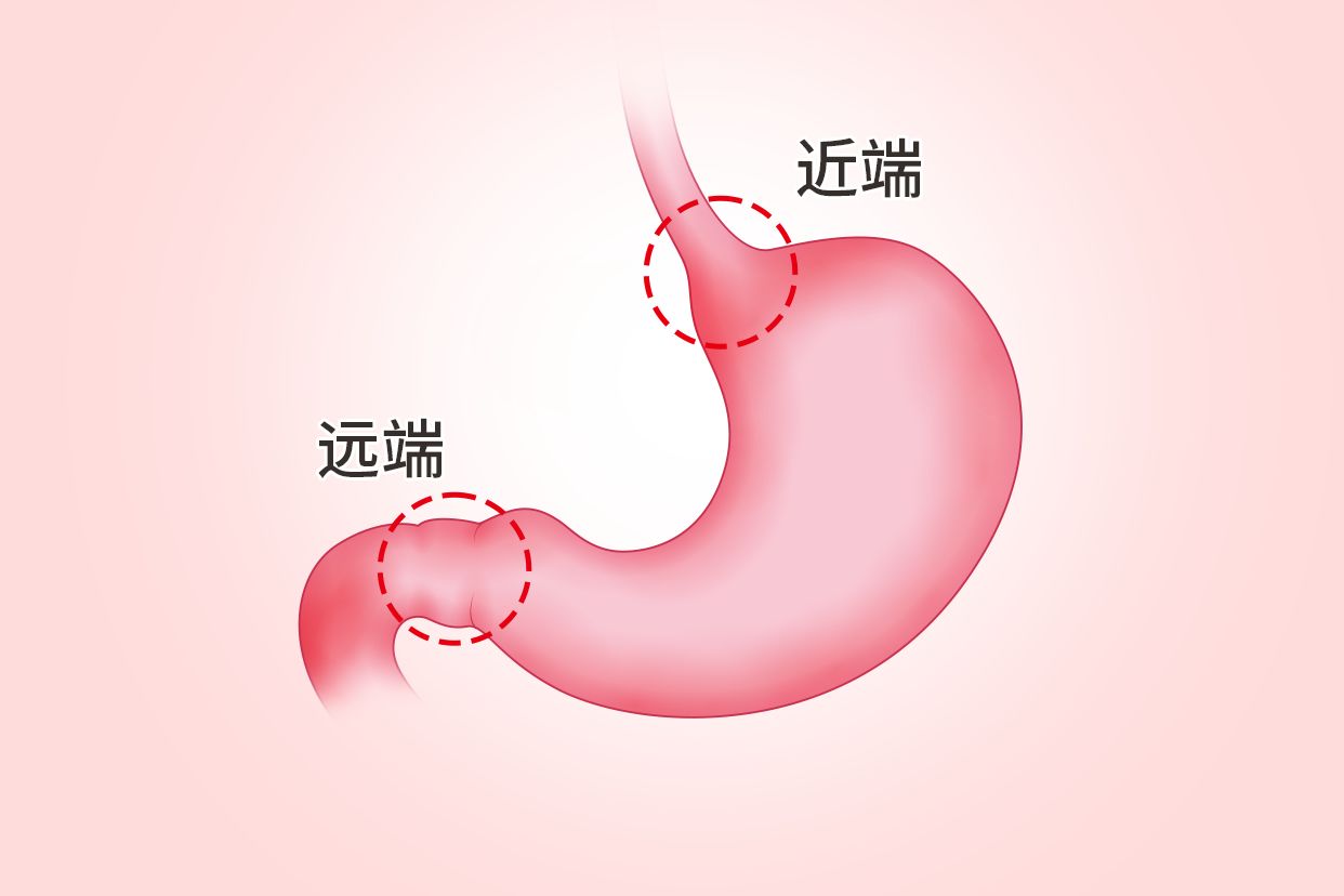 胃远端与近端的区别图 胃远端与近端的区别图片大全