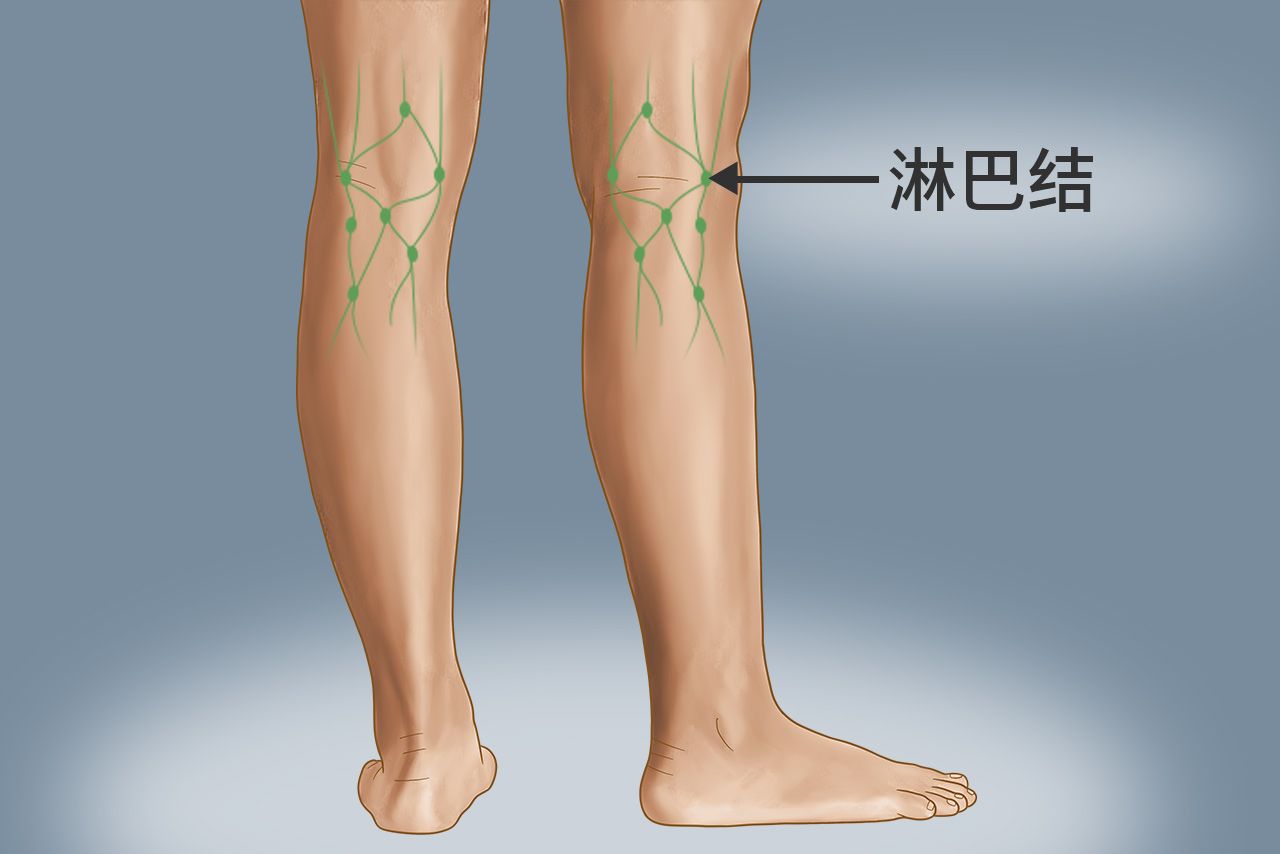 腿部腘窝淋巴结位置图片 腿窝的淋巴结在哪里