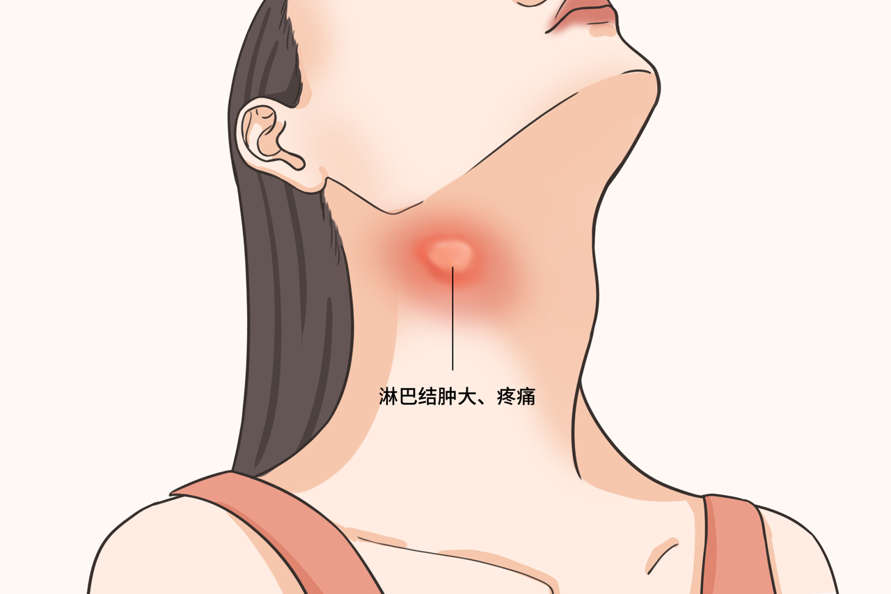 女性右侧颈部淋巴结肿大图片 女性右侧颈部淋巴结肿大图片真实