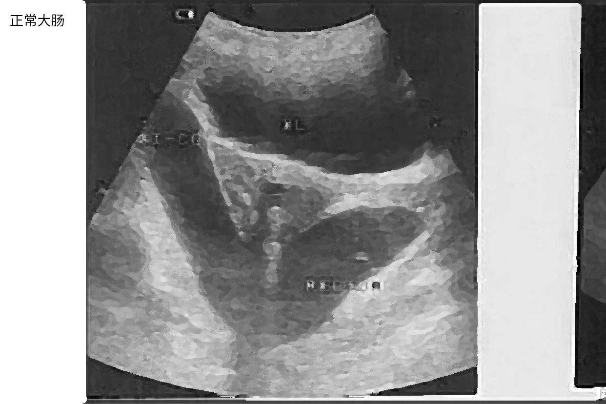 大肠和小肠的超声图像 大肠和小肠的超声图像区别