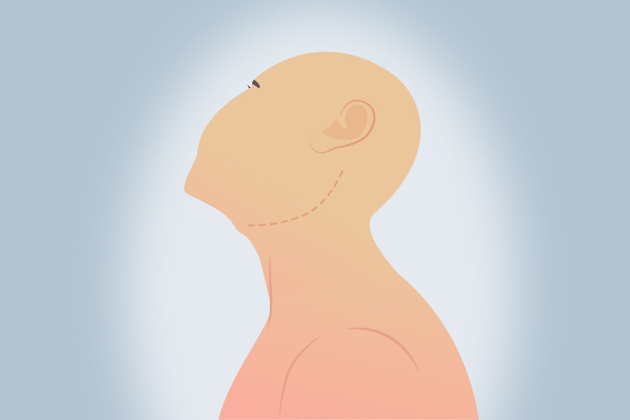 颈部手术切口方向图（颈部手术切口图片）