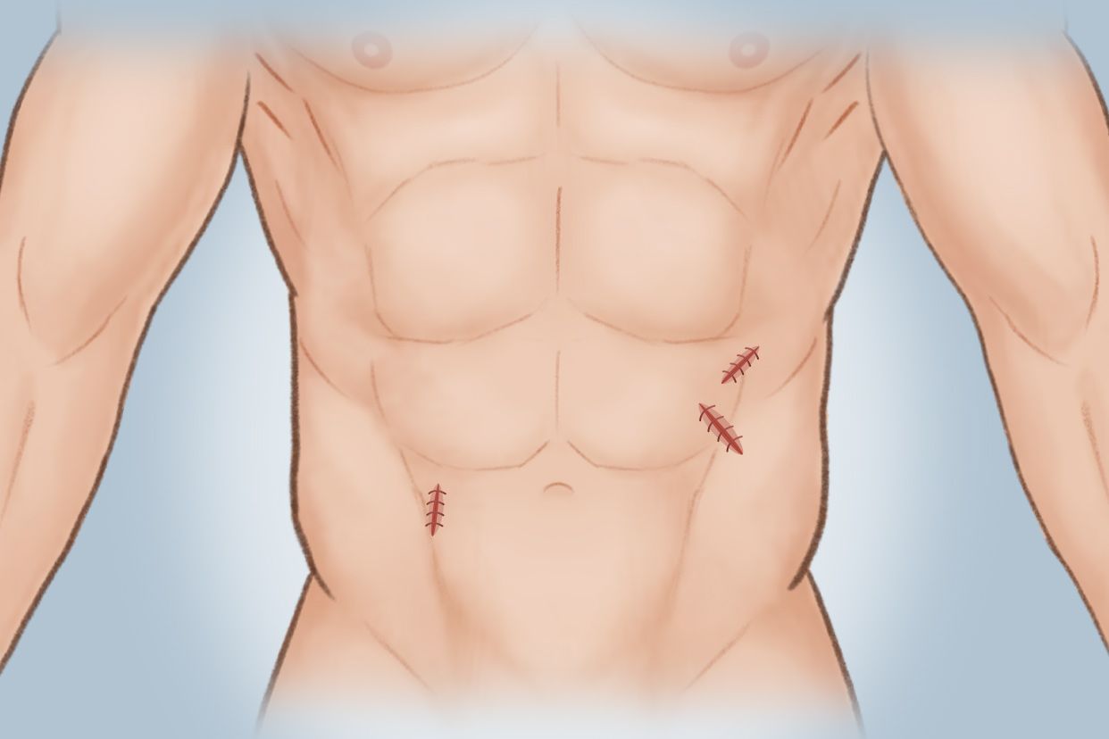 腹部补片手术后图片 腹腔补片手术后图片