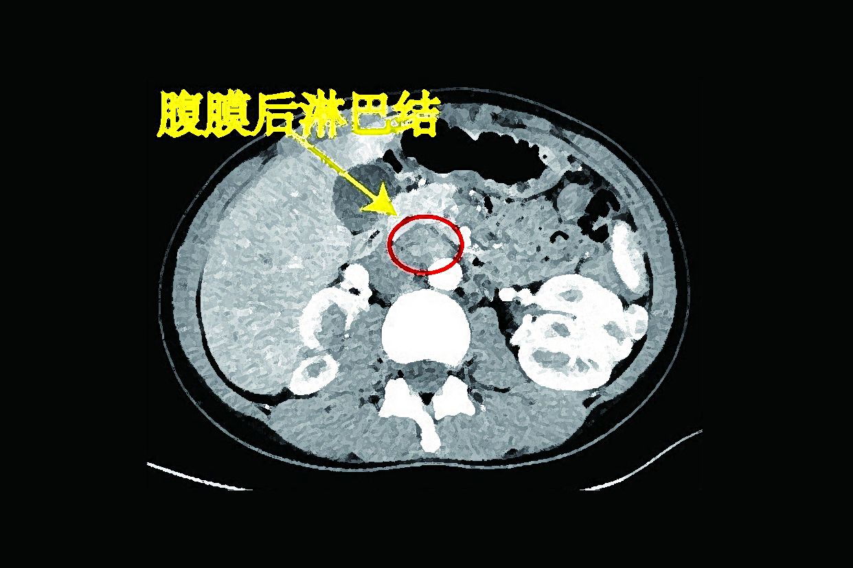 腹膜后淋巴结ct图像（腹膜后淋巴结ct图像描述）