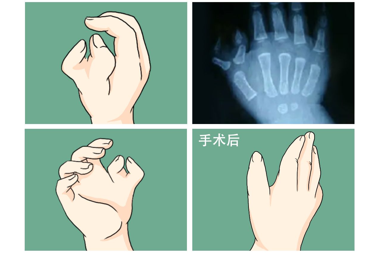 成人蟹钳指手术后图片 蟹钳手指手术前后照片