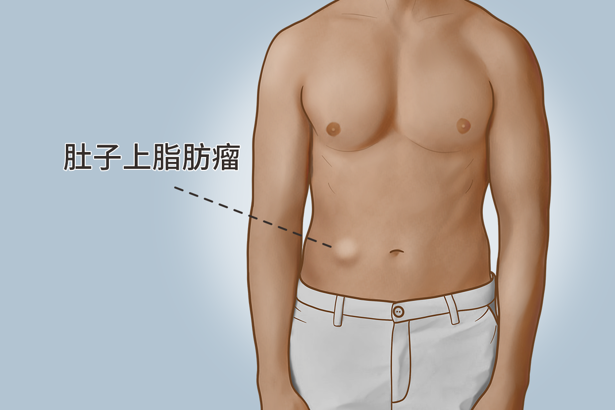 腹部多发脂肪瘤图片 腹部大量脂肪瘤