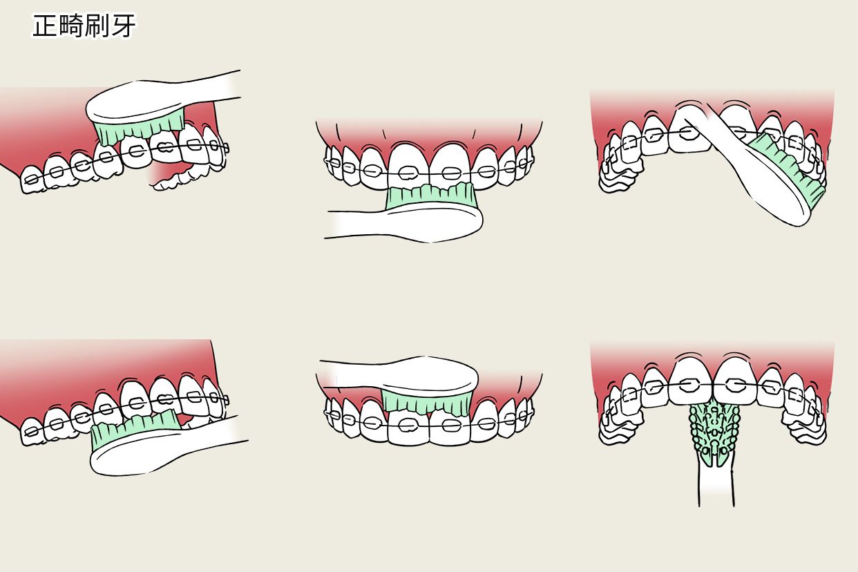 正畸刷牙步骤图片（正畸牙齿的刷牙方法视频）