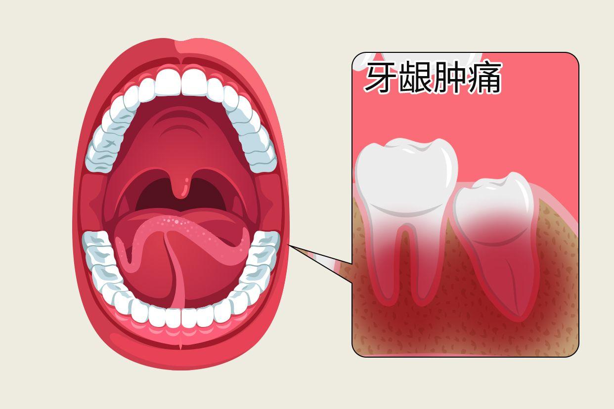 最里面的牙龈肿痛图片 牙龈肿疼的图片