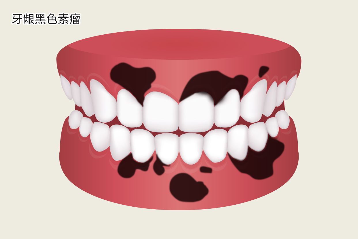 牙龈黑色素瘤图片（牙龈恶性黑色素瘤图片）