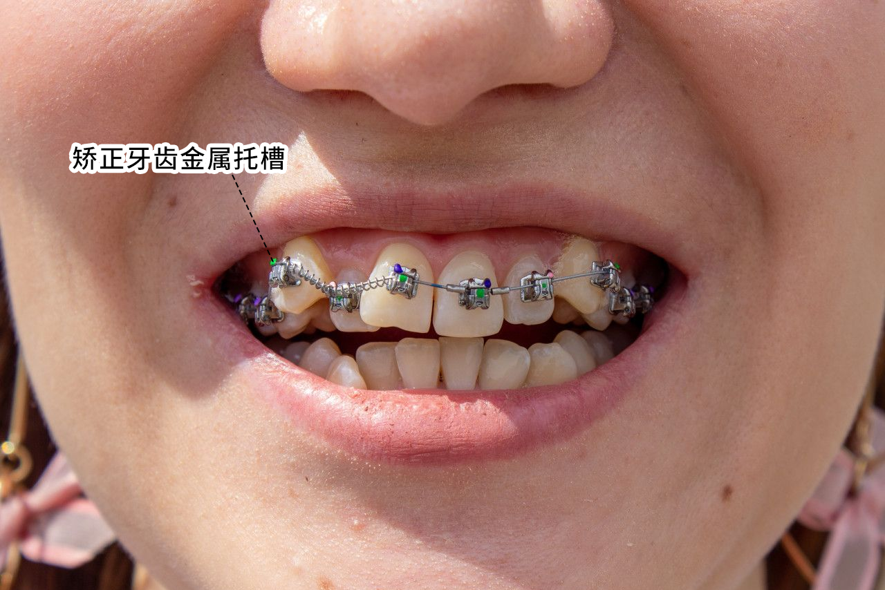 矫正牙齿金属托槽图片（正畸金属托槽）