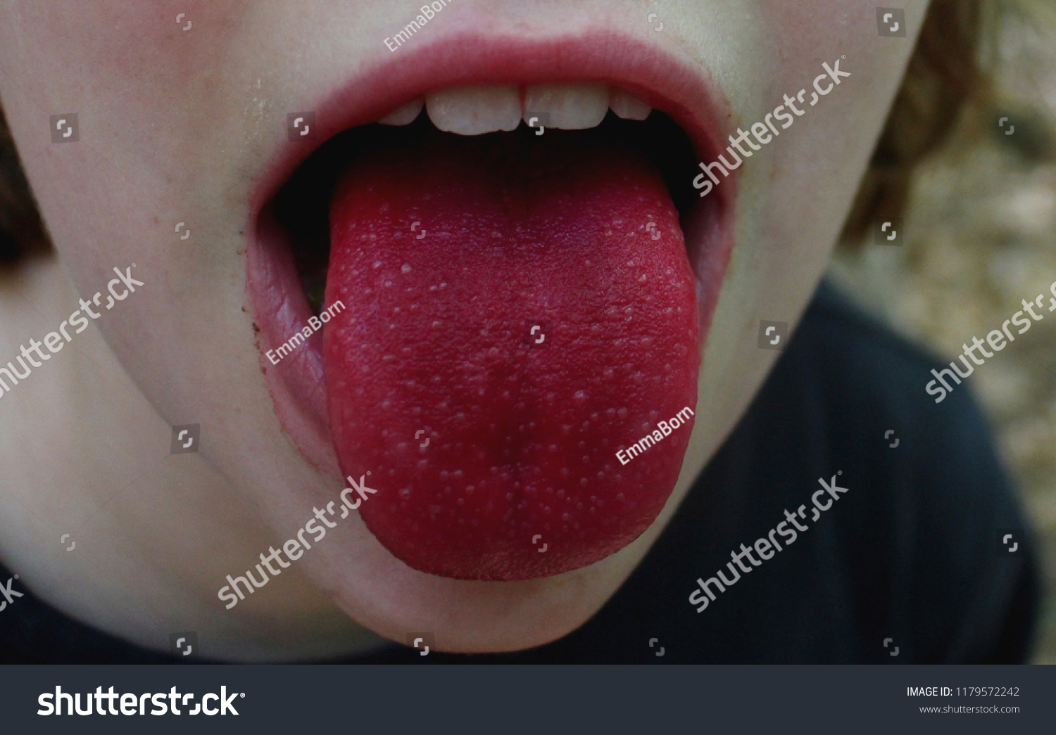 舌红是什么症状图片（舌红的图片）