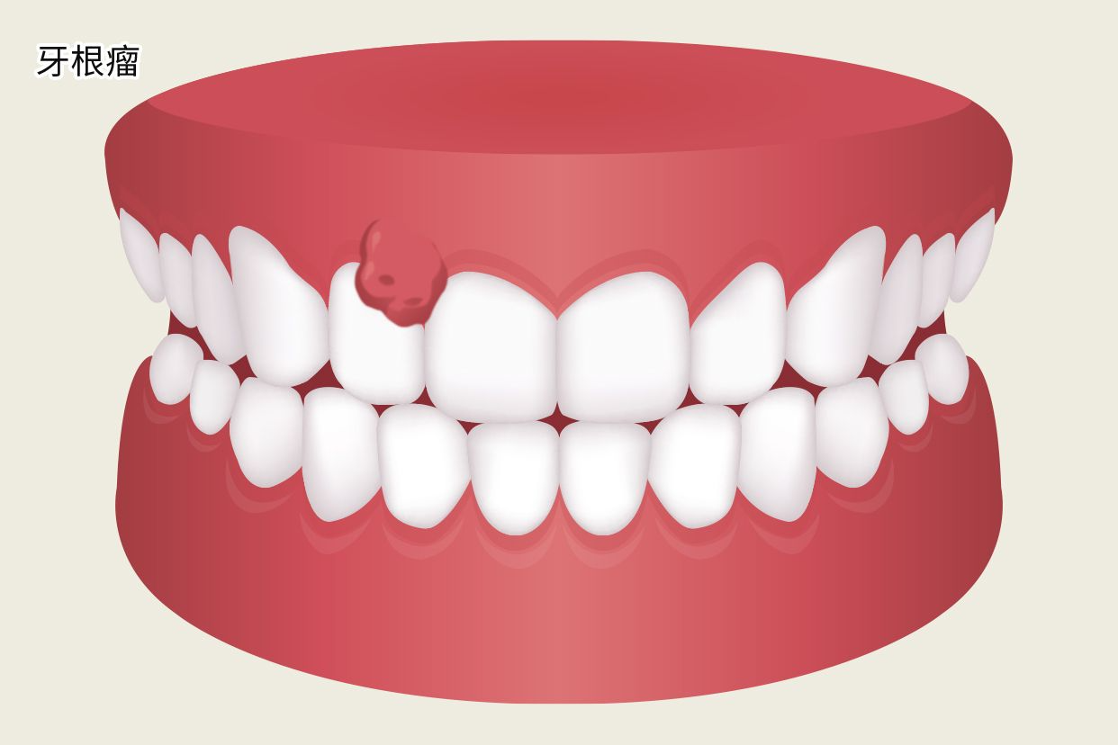 牙根瘤照片（牙本质瘤图片）