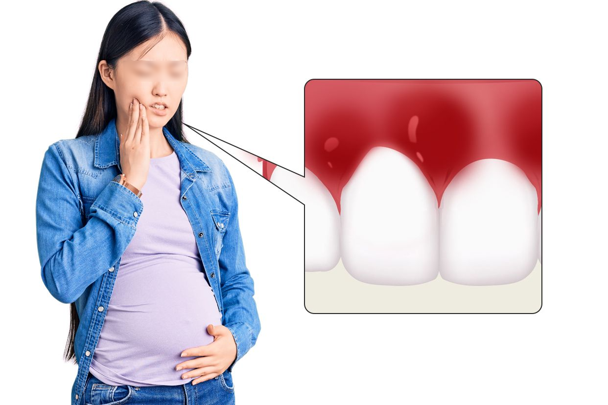 妊娠期牙龈炎图片（妊娠期牙龈炎图片溃疡假膜）
