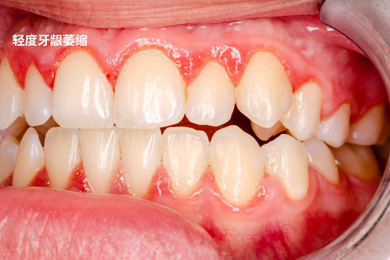轻度牙龈萎缩图片初期（牙龈萎缩各个阶段图片）