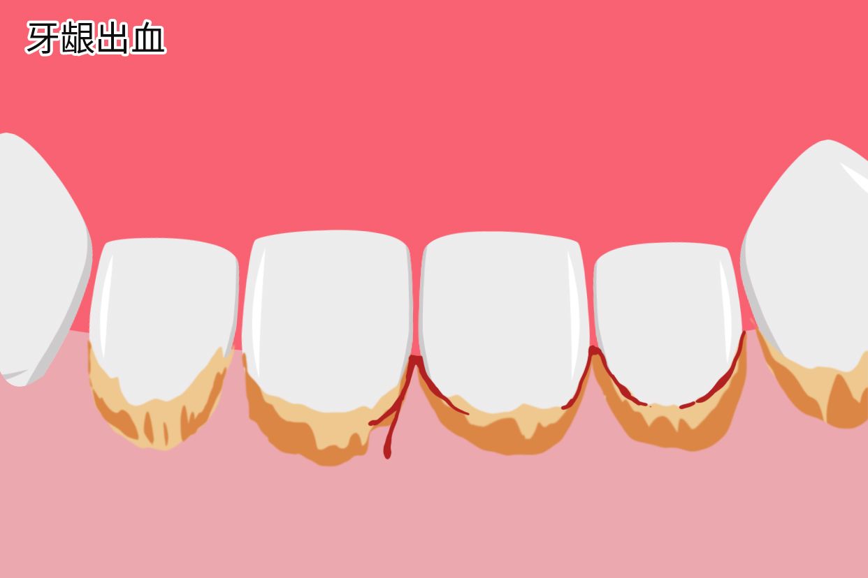 牙结石会导致牙龈出血吗图片（牙结石会导致牙龈出血吗图片大全）