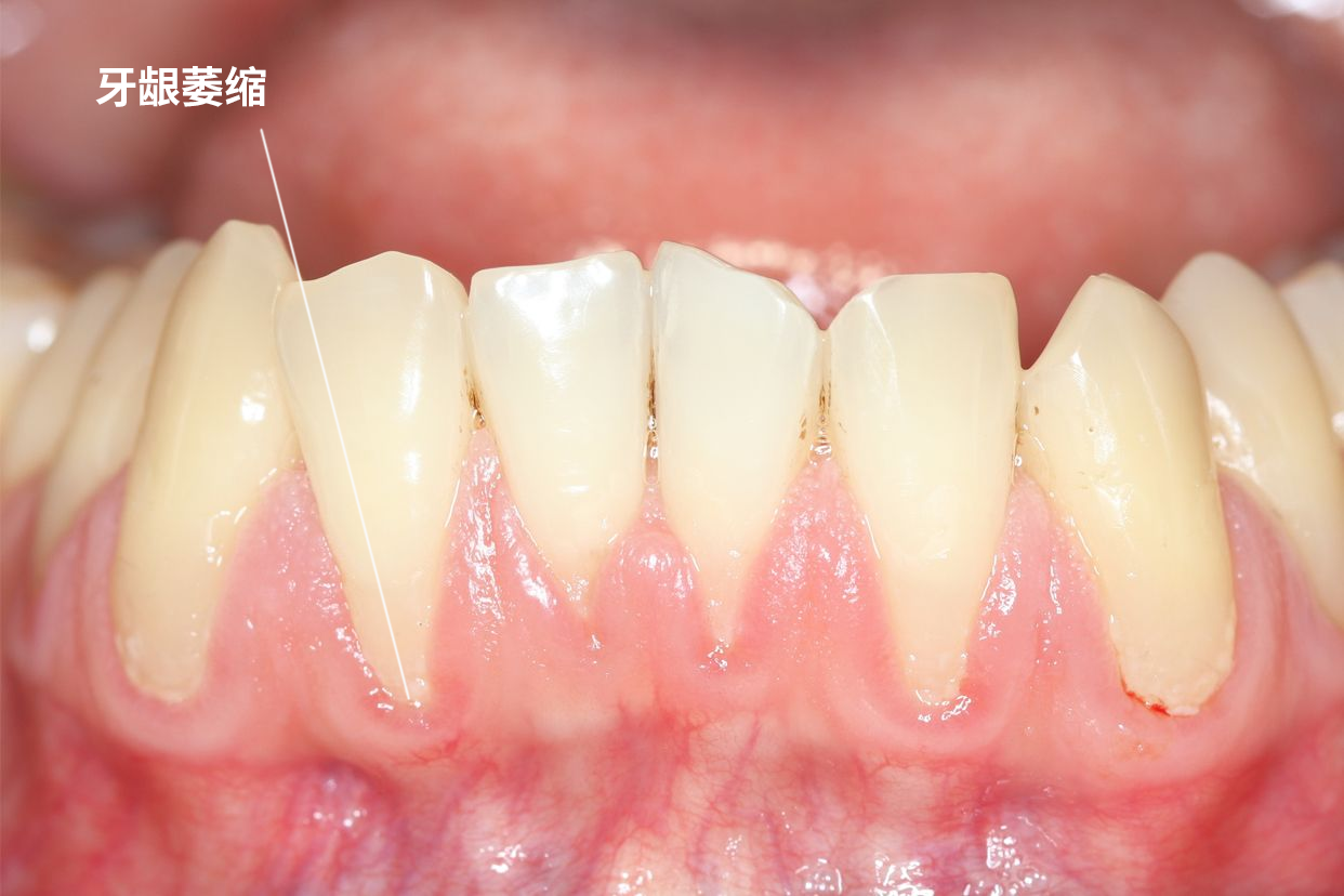 女人牙龈萎缩的图片（牙龈萎缩初期图片）