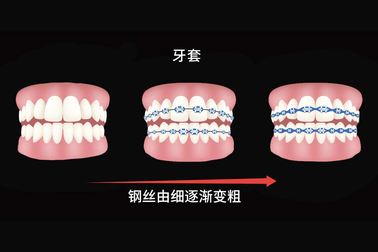 牙套换钢丝粗细顺序图片 牙齿矫正挂皮筋属于什么时期