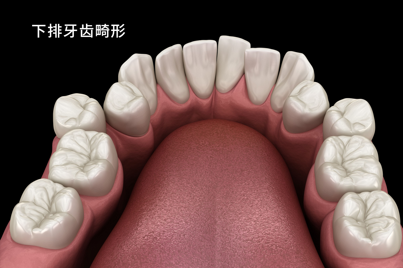 下排牙齿畸形图（牙齿下排图片）