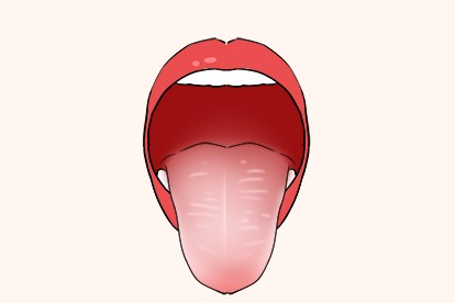 舌红苔白图片 舌红苔白腻图片