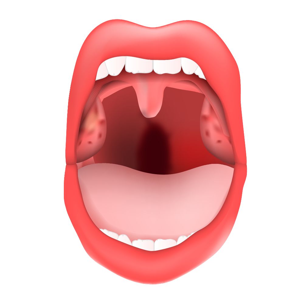 舌弓发炎图片 腭舌弓发炎图片