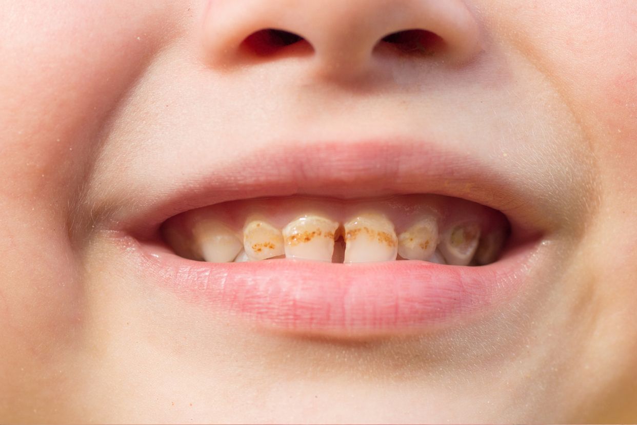 门牙龋齿严重程度分型图片 门牙中度龋齿图片