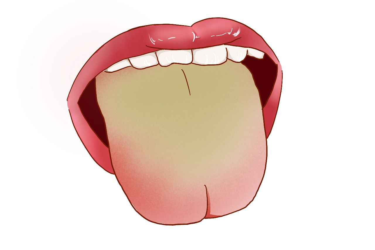 膀胱湿热舌苔图片（膀胱湿热舌苔图片）