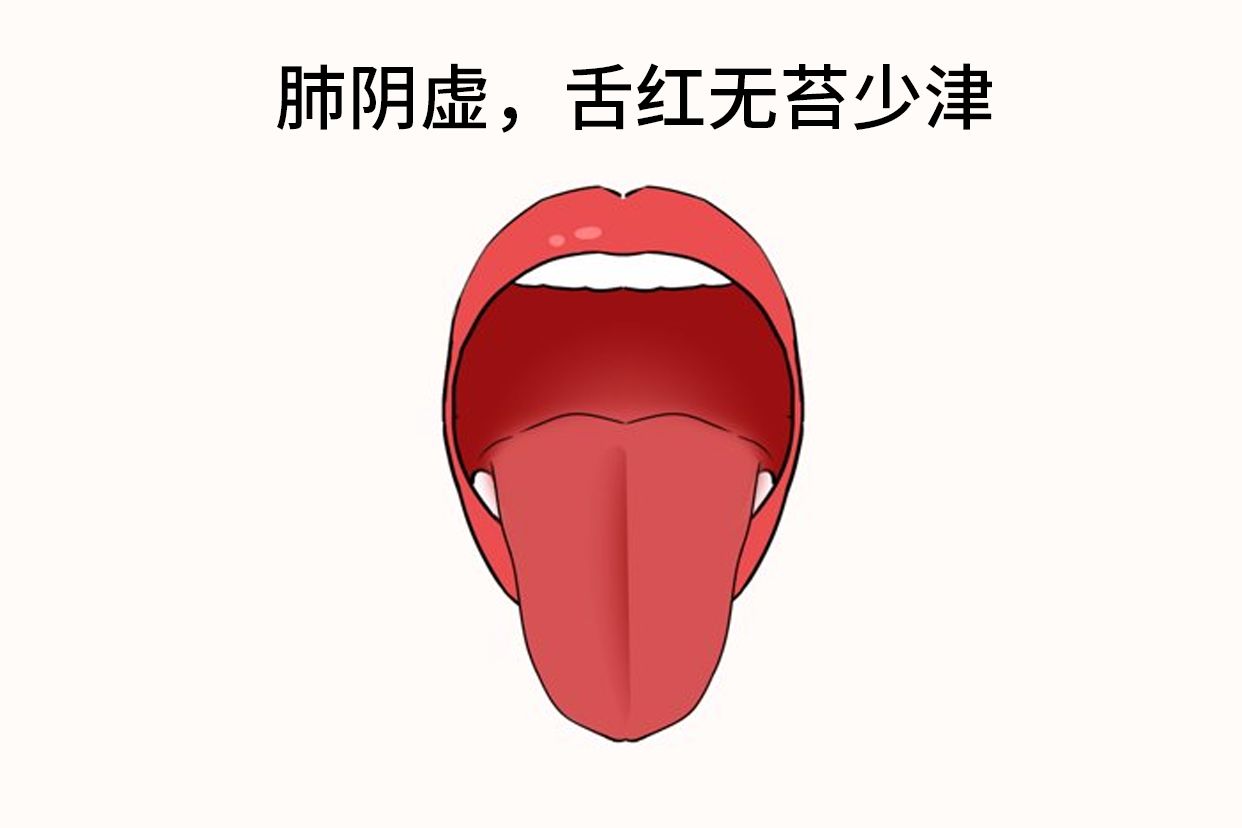肺阴虚的舌头图片（肺阴虚舌苔怎么看）