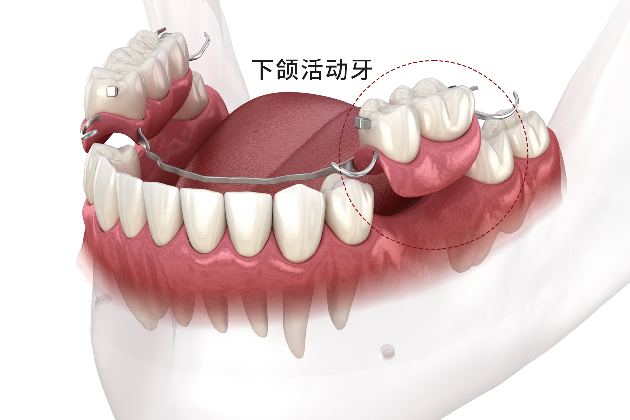下颌活动牙图片（下颌活动义齿图片）
