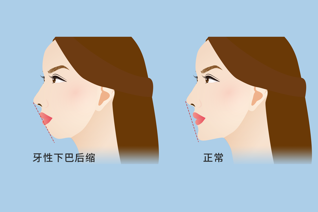 牙性下巴后缩图片（龅牙下巴后缩图片）